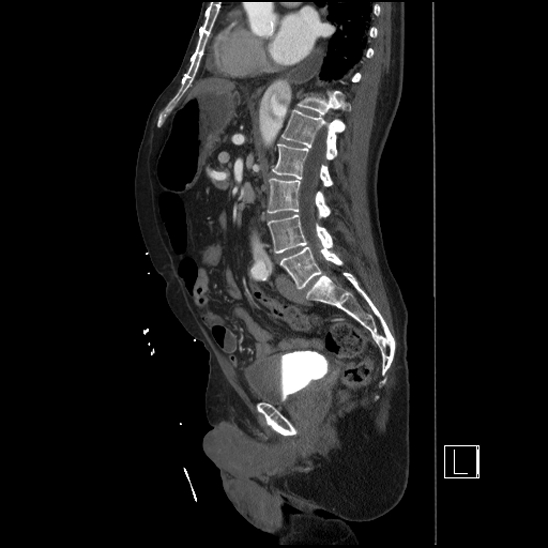Aortic dissection (CTPA) (Radiopaedia 75506-86750 G 59).jpg