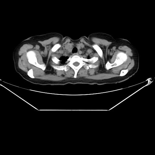 Aortic dissection (Radiopaedia 25350-25604 B 8).jpg