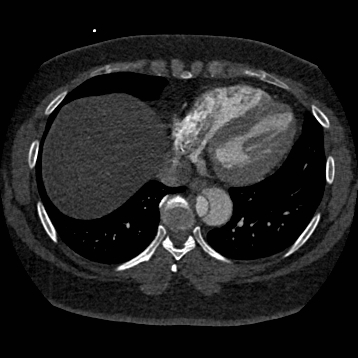 Aortic dissection (Radiopaedia 57969-64959 A 222).jpg