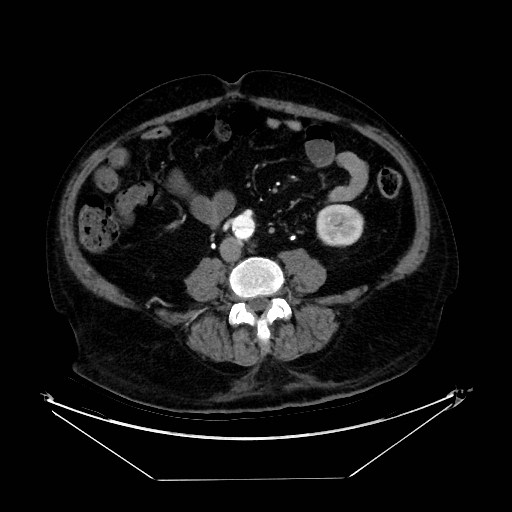 Aortic dissection (Radiopaedia 62562-71000 A 78).jpg