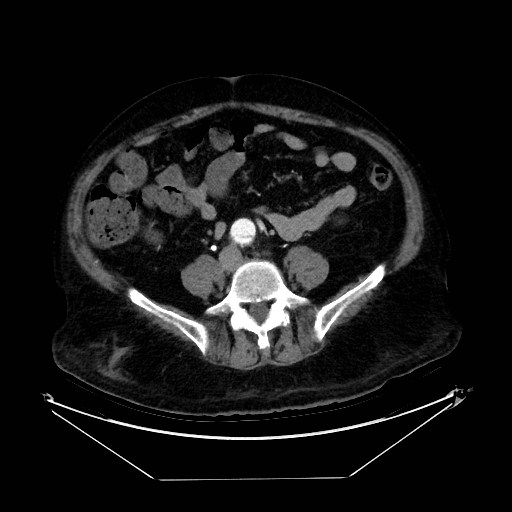 Aortic dissection (Radiopaedia 62562-71000 A 82).jpg