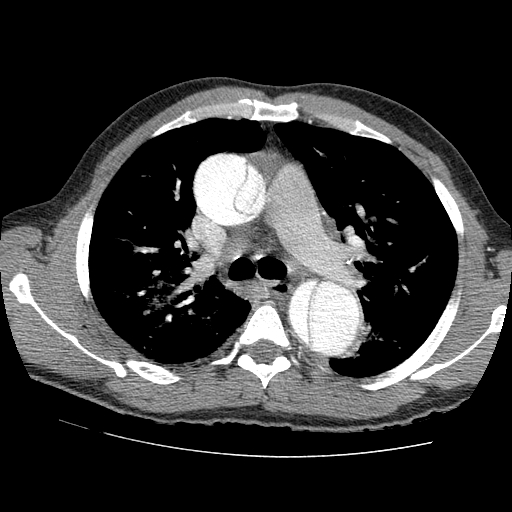 File:Aortic dissection - Stanford A -DeBakey I (Radiopaedia 28339-28587 B 28).jpg