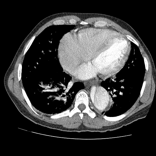 File:Aortic dissection - Stanford A -DeBakey I (Radiopaedia 28339-28587 B 68).jpg