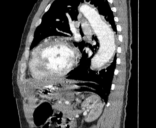 Aortic dissection - Stanford A -DeBakey I (Radiopaedia 28339-28587 C 65).jpg