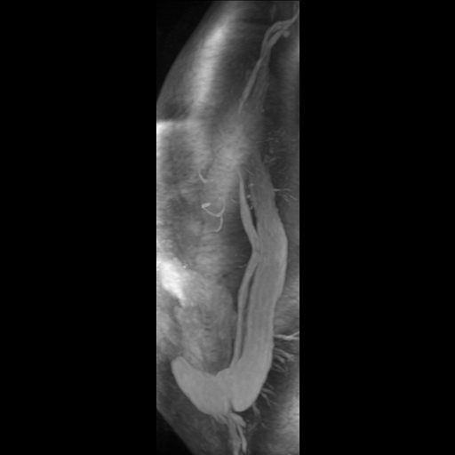 File:Aortic dissection - Stanford A - DeBakey I (Radiopaedia 23469-23551 D 18).jpg