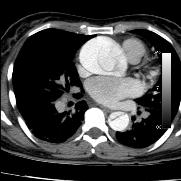 Aortic dissection - Stanford type A (Radiopaedia 29247-29659 A 44).jpg