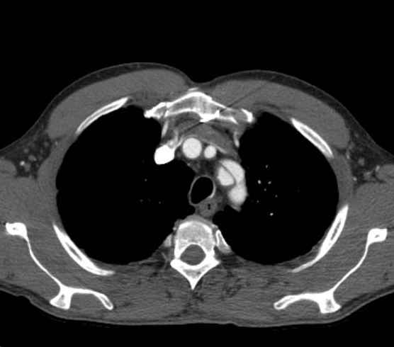 Aortic dissection - Stanford type B (Radiopaedia 73648-84437 A 12).jpg