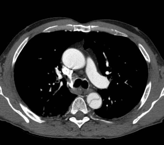 Aortic dissection - Stanford type B (Radiopaedia 73648-84437 A 36).jpg