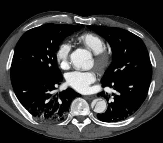 Aortic dissection - Stanford type B (Radiopaedia 73648-84437 A 63).jpg