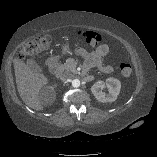 Aortic dissection - Stanford type B (Radiopaedia 88281-104910 A 113).jpg