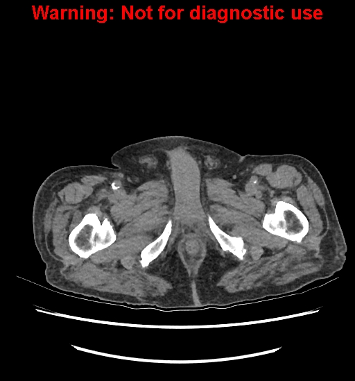 Aortic graft infection (Radiopaedia 44979-48907 Axial non-contrast 101).jpg