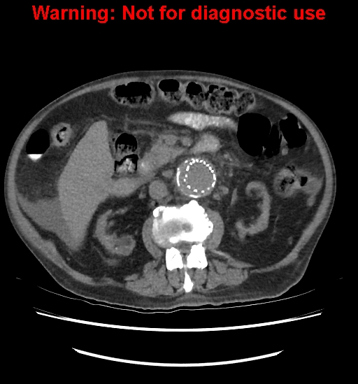 Aortic graft infection (Radiopaedia 44979-48907 Axial non-contrast 46).jpg