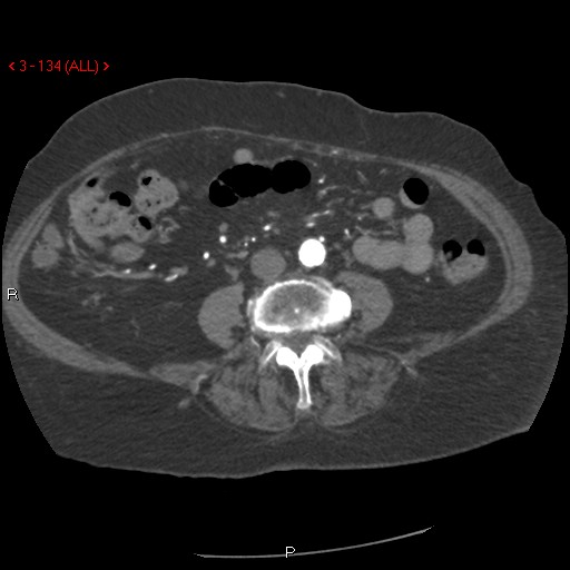 Aortic intramural hematoma (Radiopaedia 27746-28001 A 134).jpg