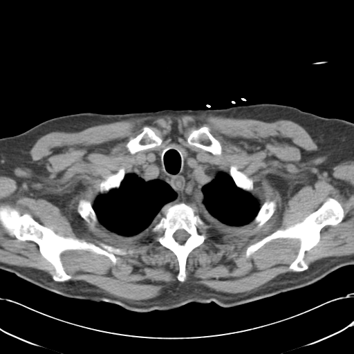 Aortic intramural hematoma (Radiopaedia 34260-35540 Axial non-contrast 8).png