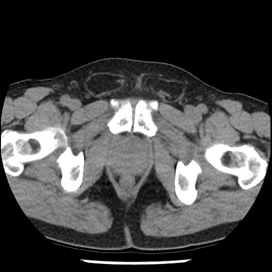 Aortic intramural hematoma (type B) (Radiopaedia 79323-92387 Axial non-contrast 116).jpg