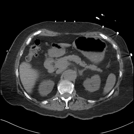Aortic intramural hematoma with dissection and intramural blood pool (Radiopaedia 77373-89491 Axial non-contrast 104).jpg