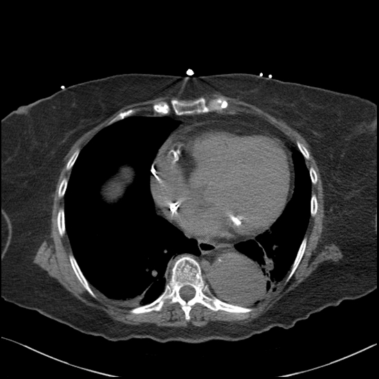 File:Aortic intramural hematoma with dissection and intramural blood pool (Radiopaedia 77373-89491 Axial non-contrast 64).jpg