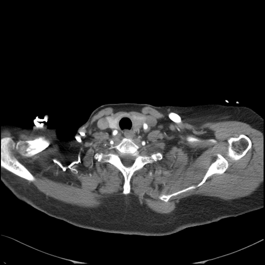 File:Aortic intramural hematoma with dissection and intramural blood pool (Radiopaedia 77373-89491 B 22).jpg