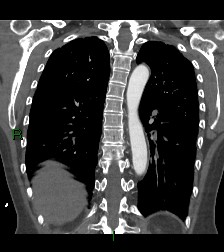 Aortic valve endocarditis (Radiopaedia 87209-103485 D 20).jpg