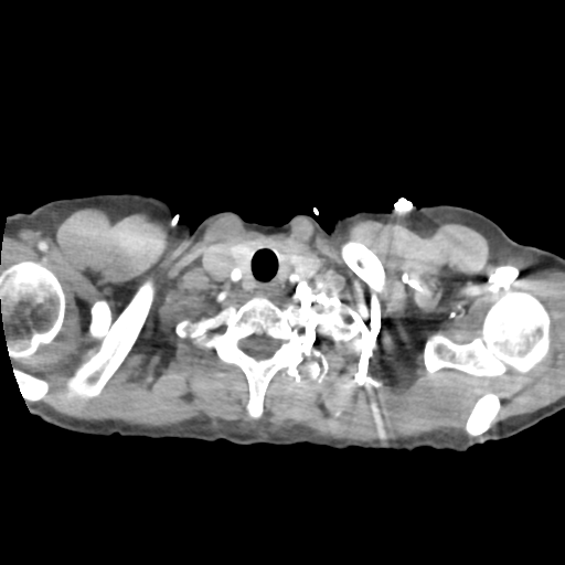 Aortic valve non-coronary cusp thrombus (Radiopaedia 55661-62189 B 3).png