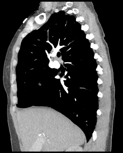 Aortic valve non-coronary cusp thrombus (Radiopaedia 55661-62189 D 34).png