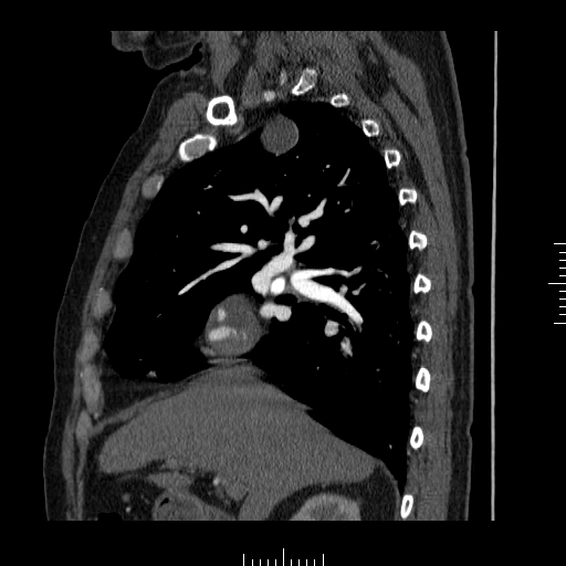 File:Aorto-coronary bypass graft aneurysms (Radiopaedia 40562-43157 C 7).png
