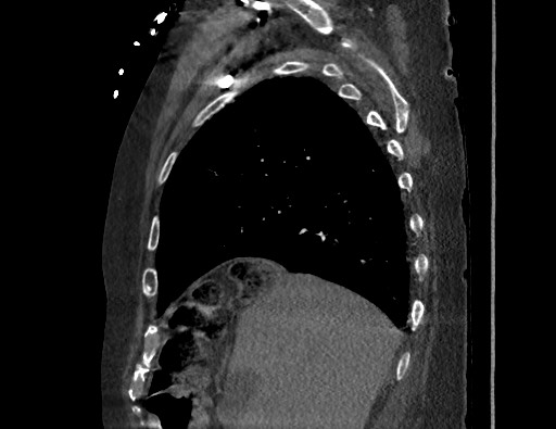 File:Aortoesophageal fistula with endovascular repair (Radiopaedia 73781-84592 Sagittal C+ CTPA 42).jpg