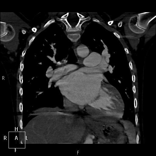 File:Aortopulmonary septal defect (Radiopaedia 41990-45013 Coronal C+ CTPA 34).jpg