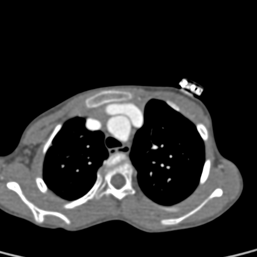 File:Aortopulmonary window, interrupted aortic arch and large PDA giving the descending aorta (Radiopaedia 35573-37074 B 21).jpg