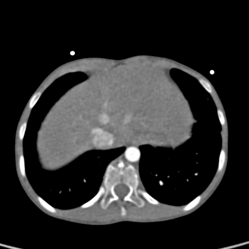 File:Aortopulmonary window, interrupted aortic arch and large PDA giving the descending aorta (Radiopaedia 35573-37074 B 80).jpg