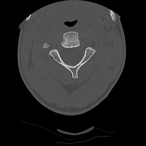 File:Apical pneumothorax on cervical spine CT (Radiopaedia 45343-49368 Axial bone window 26).jpg