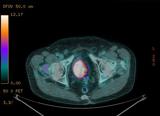 Appendiceal adenocarcinoma complicated by retroperitoneal abscess (Radiopaedia 58007-65041 Axial PET-CT 185).jpg