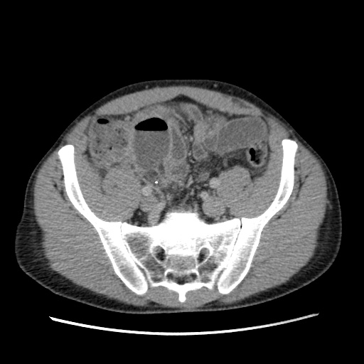 File:Appendicitis complicated by post-operative collection (Radiopaedia 35595-37114 A 65).jpg