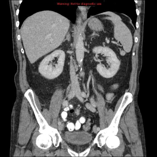 File:Appendicitis mass in inguinal hernia (Radiopaedia 26858-27029 B 41).jpg
