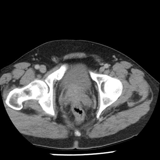 Appendicitis with perforation (Radiopaedia 35790-37342 A 50).jpg