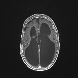 Aqueductal stenosis (Radiopaedia 73974-84802 Axial T1 C+ 90).jpg