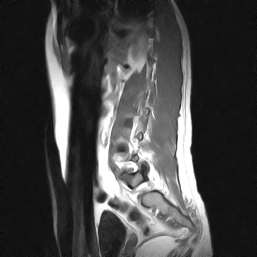 File:Arachnoid cyst - spinal (Radiopaedia 66835-76157 Sagittal T1 11).jpg