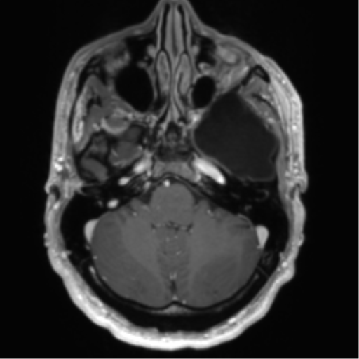 File:Arachnoid cyst with subdural hematoma (Radiopaedia 85892-101743 Axial T1 C+ 22).png