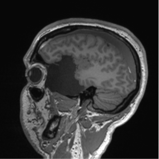 Arachnoid cyst with subdural hematoma (Radiopaedia 85892-101743 Sagittal T1 27).png