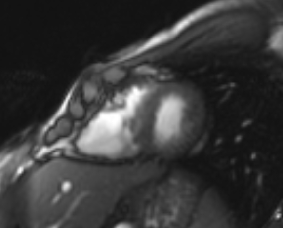 Arrhythmogenic right ventricular cardiomyopathy (Radiopaedia 69564-79464 short axis cine 89).jpg