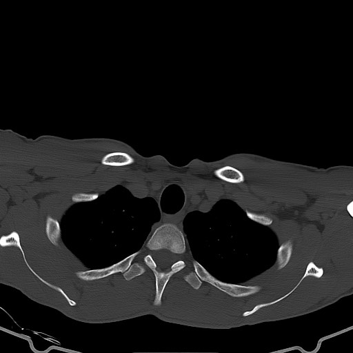 Arrow injury to the brain (Radiopaedia 72101-82607 Axial bone window 1).jpg
