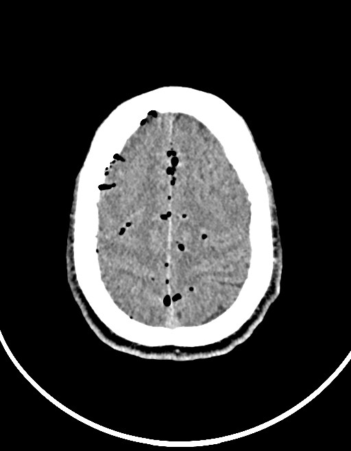 Arrow injury to the brain (Radiopaedia 72101-82607 Axial non-contrast 86).jpg