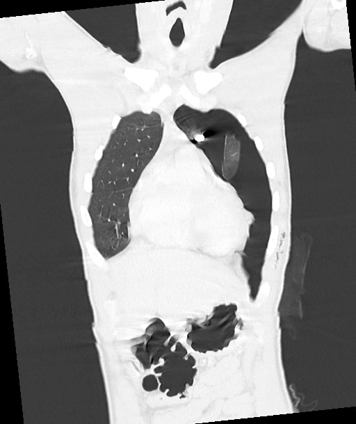 Arrow injury to the chest (Radiopaedia 85367-100975 Coronal lung window 51).jpg