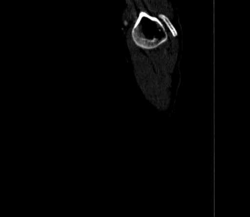 Arteria lusoria (Radiopaedia 88528-105192 C 7).jpg