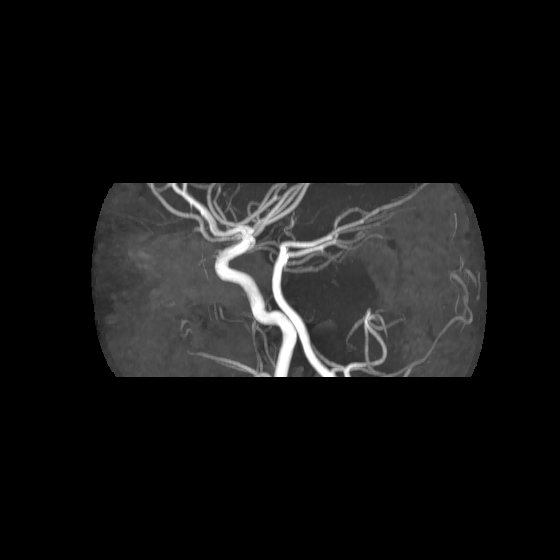 File:Artery of Percheron infarct (Radiopaedia 40966-43676 G 60).jpg