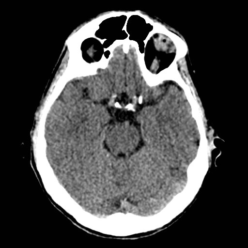 File:Artery of Percheron infarct (Radiopaedia 48088-52893 Axial non-contrast 14).jpg