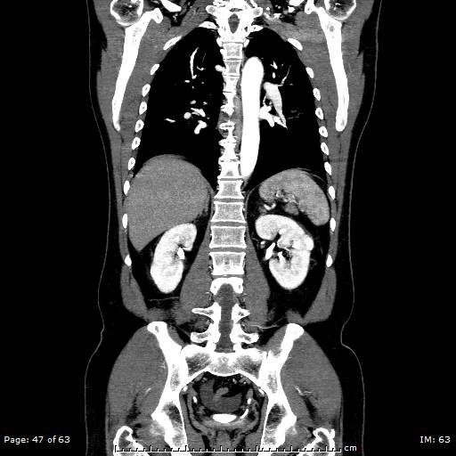 Ascending aortic aneurysm (Radiopaedia 50086-55404 B 47).jpg