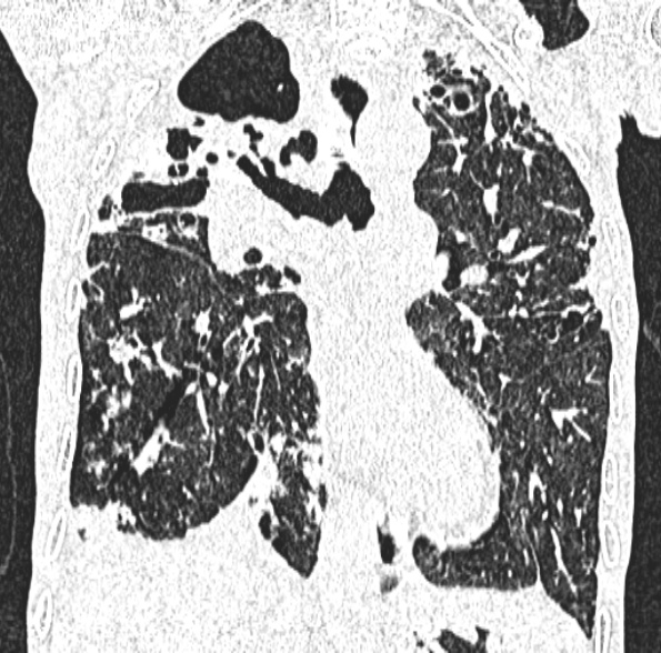 Aspergilloma- with Monod sign (Radiopaedia 44737-48532 Coronal lung window 244).jpg