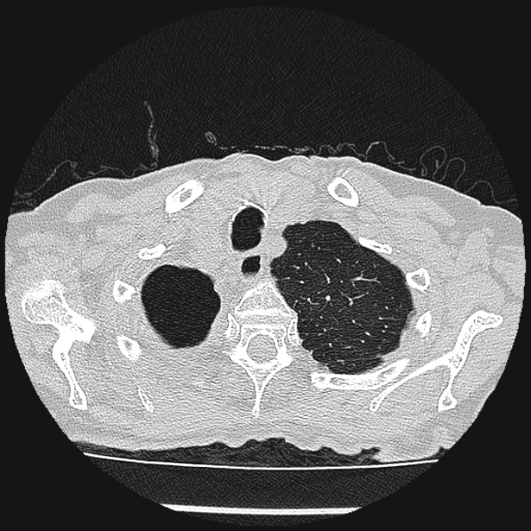 Aspergilloma (Radiopaedia 24458-24763 Axial lung window 8).jpg