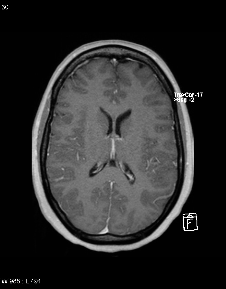 Astroblastoma (Radiopaedia 39792-42217 Axial T1 C+ 29).jpg